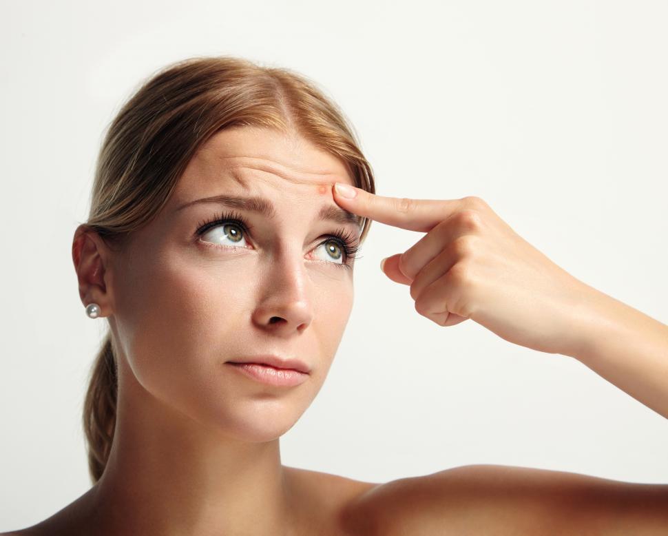 Free Image of Woman indicates with a finger a pimple on her forehead 
