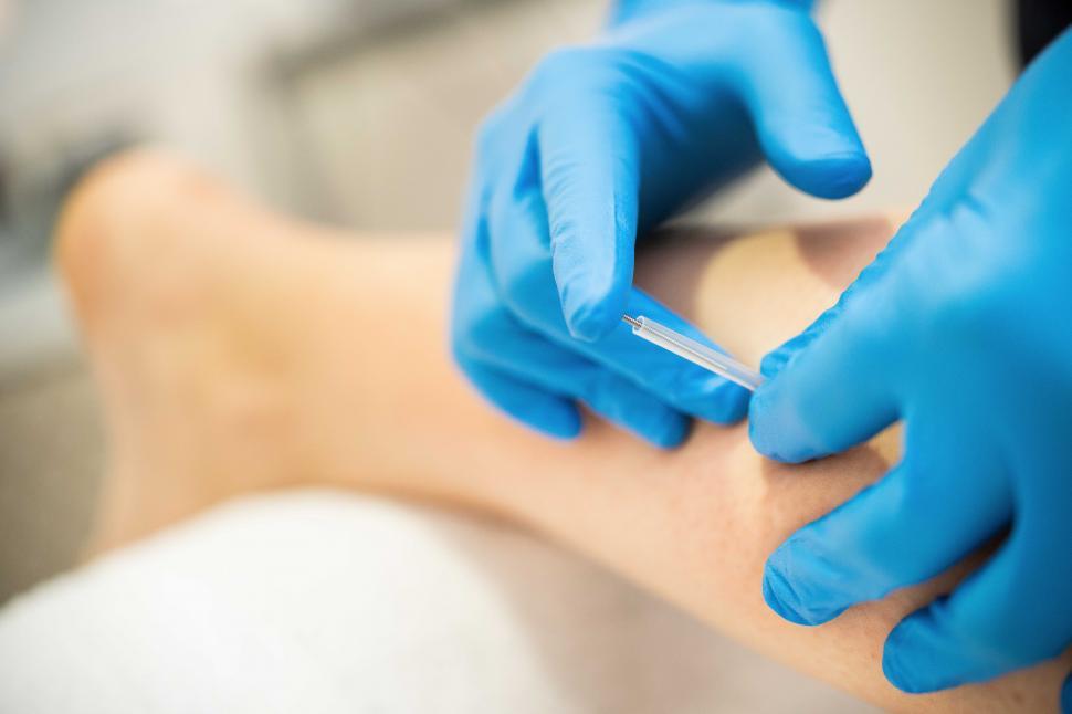 Free Image of Hands of physiotherapist doing a dry needling 
