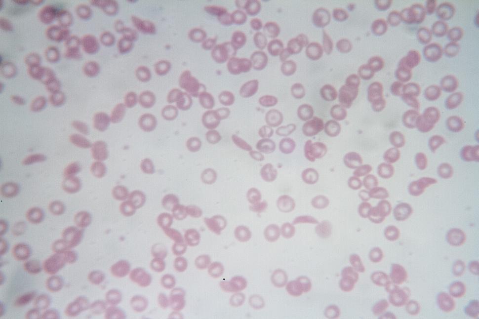 Free Image of Sickle cell anemia 